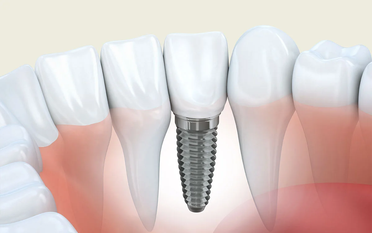 Illustration d’un implant et de sa couronne entre les dents